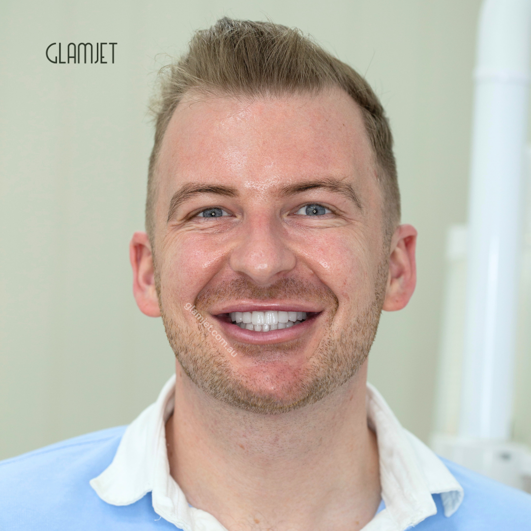Before and after smile restoration of a Melbourne executive who replaced old porcelain crowns with premium Lava 3M zirconia through Glamjet.com.au in Hanoi, Vietnam. Saved over $40,000 compared to local Melbourne dentists, enjoyed a luxury holiday arranged by the Glamjet team, and even used Super for payment.