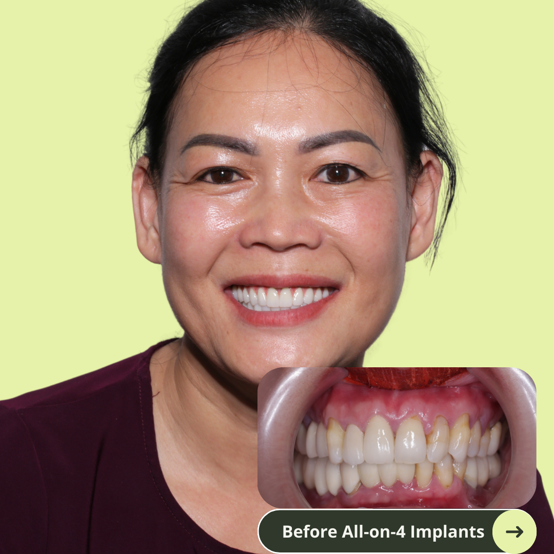 Photo of an Australian women smile after all-on-4 dental implants with porcelain bridge in Vietnam. It costs ten of thousands less than prices in Australia, the US, New Zealand. It's even cheaper than Thailand. She has beautiful white and translucent teeth after dental implants. No more missing teeth.