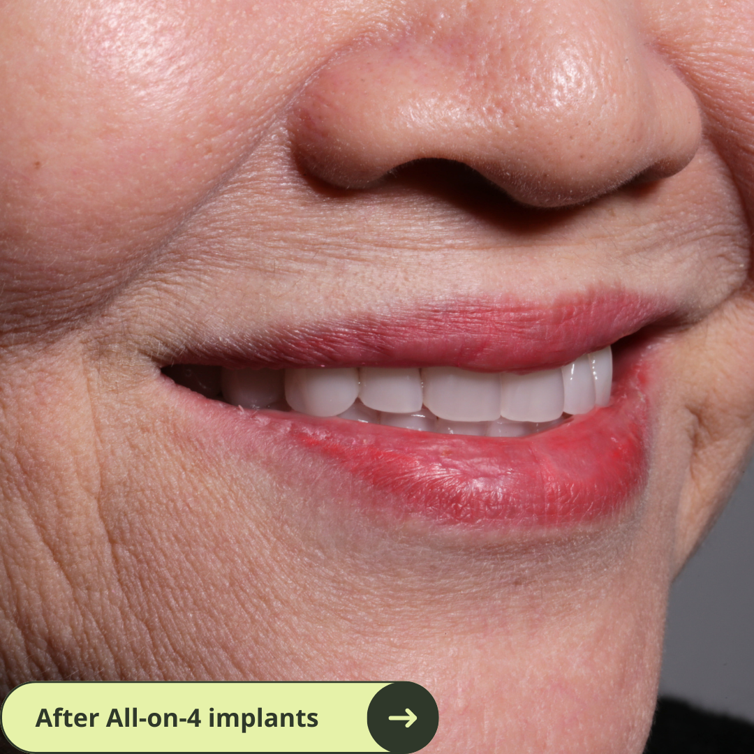 Photo of an Australian women smile after all-on-4 dental implants with porcelain bridge in Vietnam. It costs ten of thousands less than prices in Australia, the US, New Zealand. It's even cheaper than Thailand. She has beautiful white and translucent teeth after dental implants. No more missing teeth.