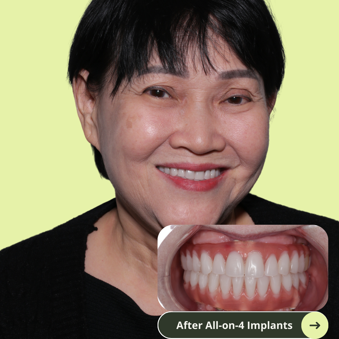 Photo of an Australian women smile after a makeover after all-on-4 dental implants in Vietnam which is much more affordable than Australia, the US, New Zealand or even Thailand. She has beautiful white and translucent teeth after dental implants. No more missing teeth.