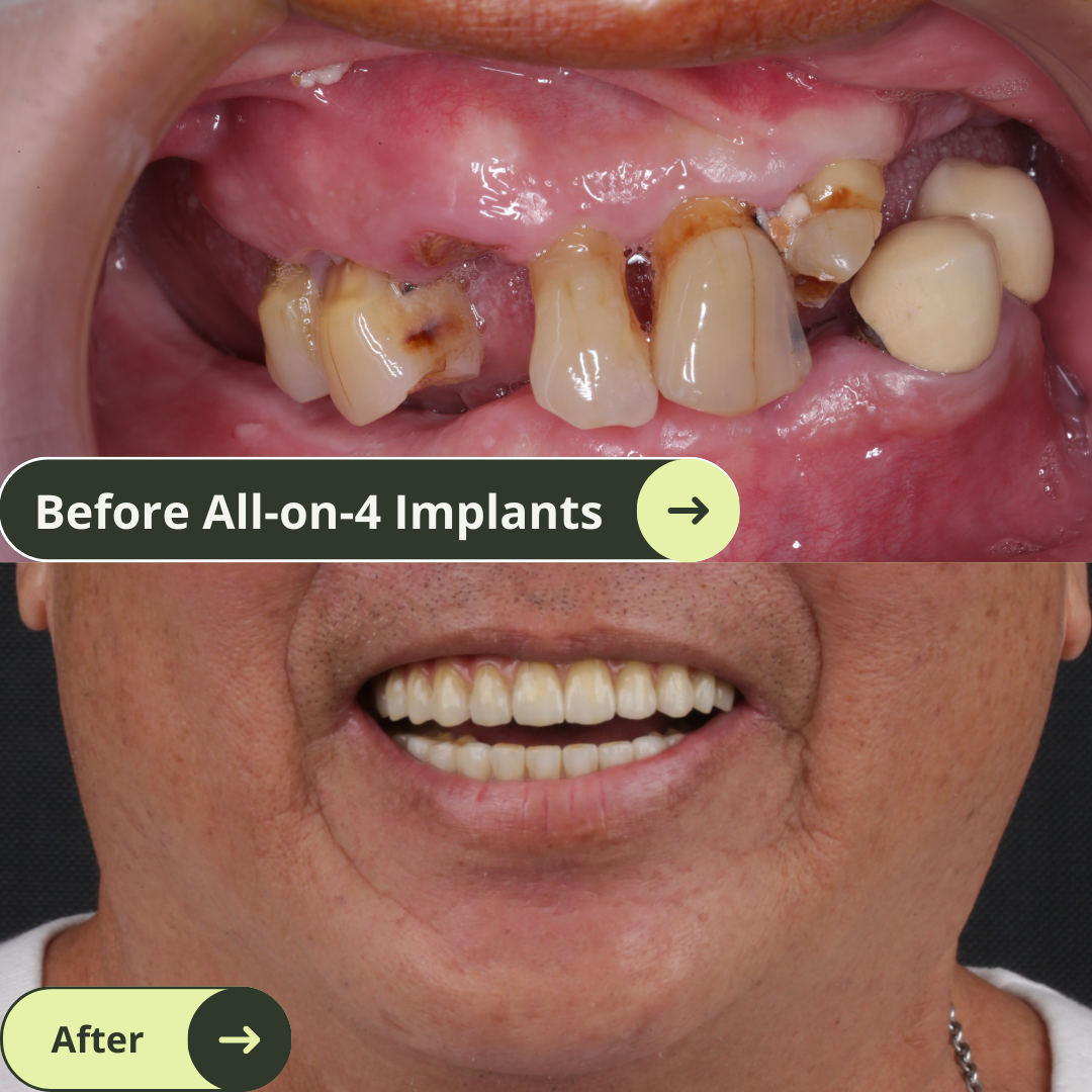 Photos of an American male client smile before and after a makeover after all-on-4 dental implants in Vietnam which is much more affordable than Australia, the US, New Zealand, and Thailand. He has beautiful white and translucent teeth.