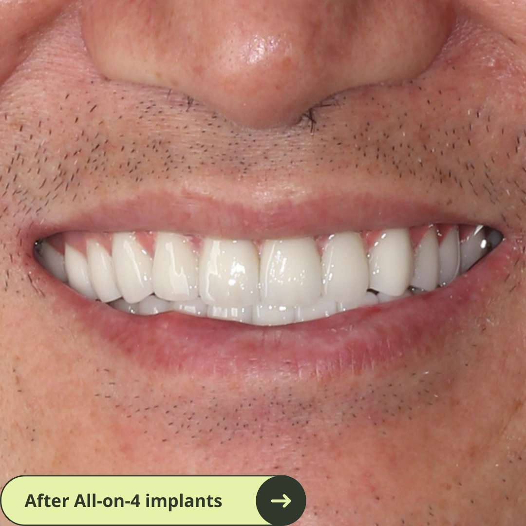Photo of an American male client smile after a makeover after all-on-4 dental implants in Vietnam which is much more affordable than Australia, the US, New Zealand. He travelled from the United States to Ho Chi Minh to have dental implants. He has beautiful white and translucent teeth now.