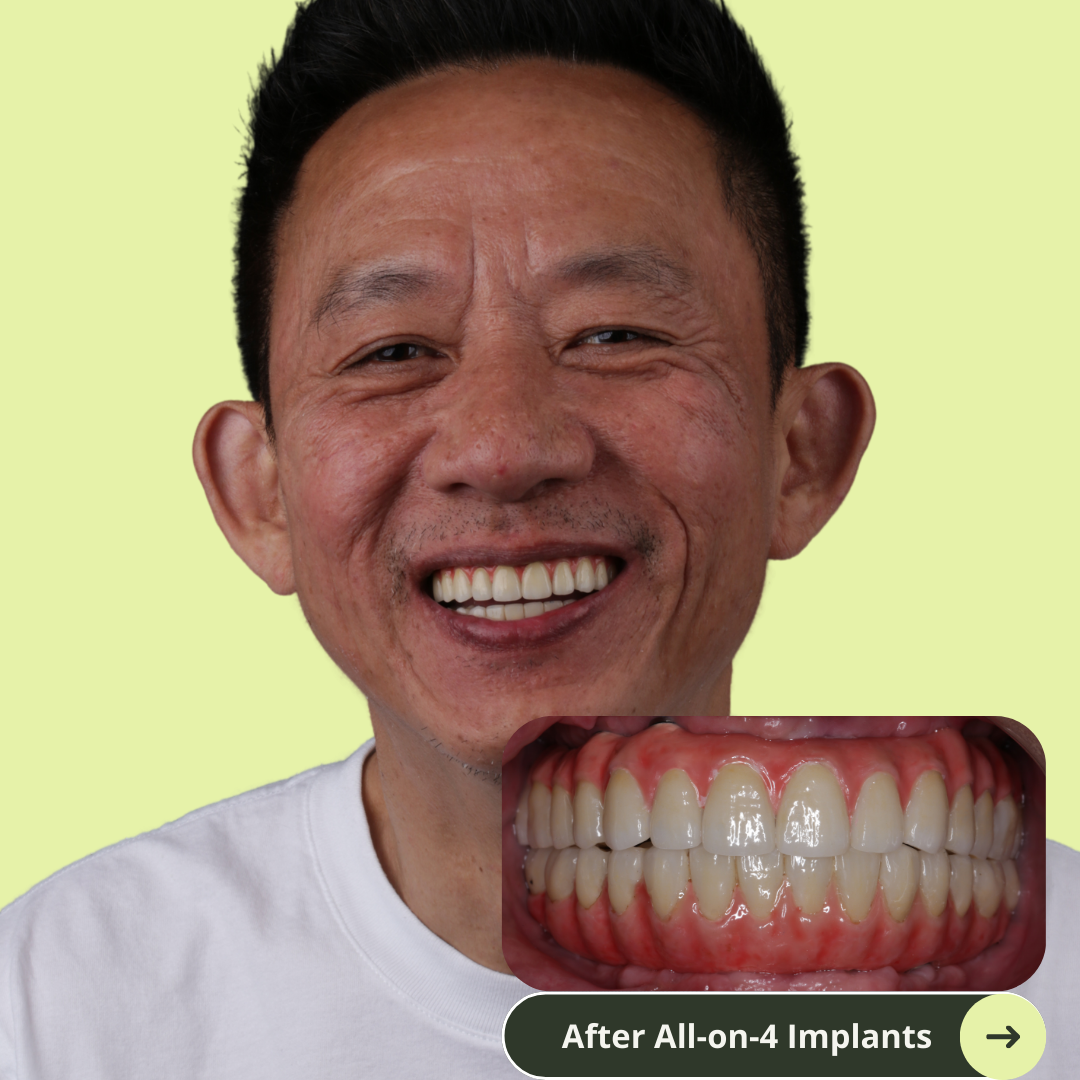 Photo of an American men smile after all-on-4 dental implants with porcelain bridge in Vietnam. It costs ten of thousands less than prices in Australia, the United States, New Zealand. It's even cheaper than Thailand. He has beautiful white and translucent teeth after dental implants. No more missing teeth.