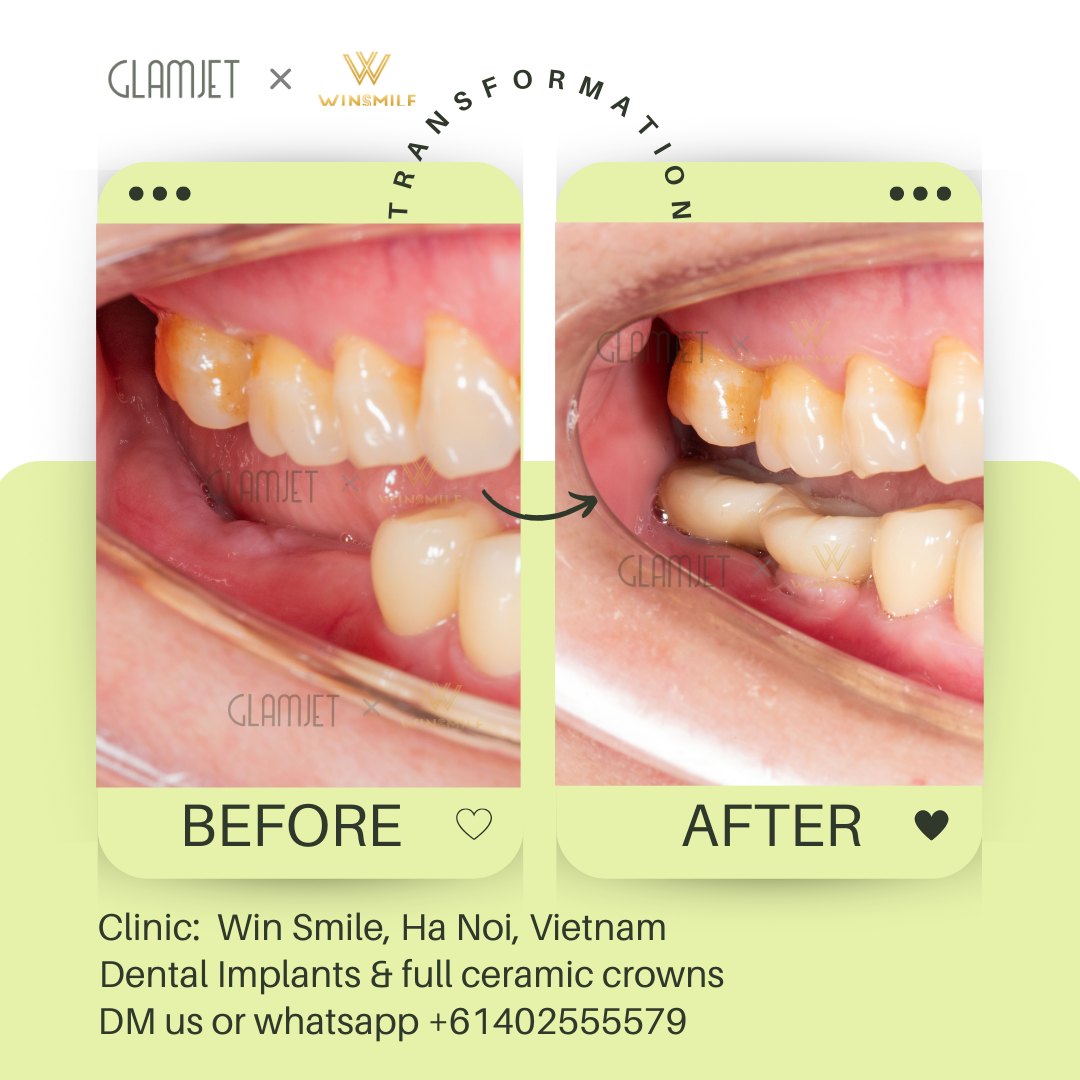 An image showcasing the before and after results of dental implant treatment for teeth loss at a top dental clinic Win Smile Dental with branches in Ha Noi and Ho Chi Minh City, Vietnam. Glamjet has assisted clients in Australia, New Zealand, America plan dental tourism holidays in Vietnam, Thailand, Bali, offering affordable porcelain crowns, no prep veneers, Emax ceramic veneers, dental implants, all-on-4 and all-on-6 implants, dentures, zygomatic implant, root canal, teeth whitening
