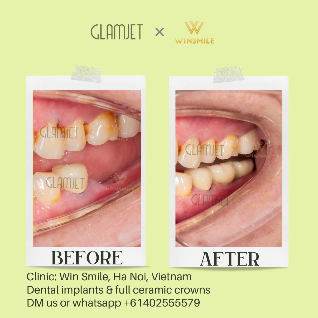 An image showcasing the before and after results of dental implant treatment for teeth loss at a leading dental clinic Win Smile Dental with branches in Ha Noi and Ho Chi Minh City, Vietnam. Glamjet has assisted numerous Australians, New Zealanders, and Americans in planning dental tourism holidays in Vietnam, Thailand, Bali, offering affordable porcelain crowns, no prep veneers, Emax ceramic veneers, dental implants, all-on-4 and all-on-6 implants, dentures, zygomatic implant, root canal, teeth whitening