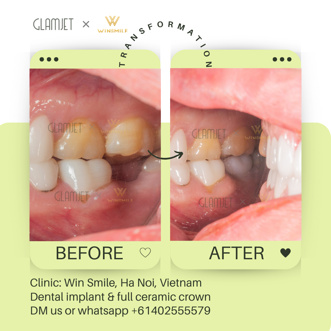 See the transformative before and after results of dental implants for teeth loss at a top 5 dental clinics in Hanoi and Ho Chi Minh City, Vietnam. Glamjet made it easy for Australians, New Zealanders, and Americans to plan dental tourism trips in Vietnam, Thailand, and Bali, ensuring affordable dental care, including porcelain crowns, ceramic veneers, dental implants, all-on-4 implants, no prep veneers, dentures, root canal treatments, teeth whitening by the best dentists with payment plans