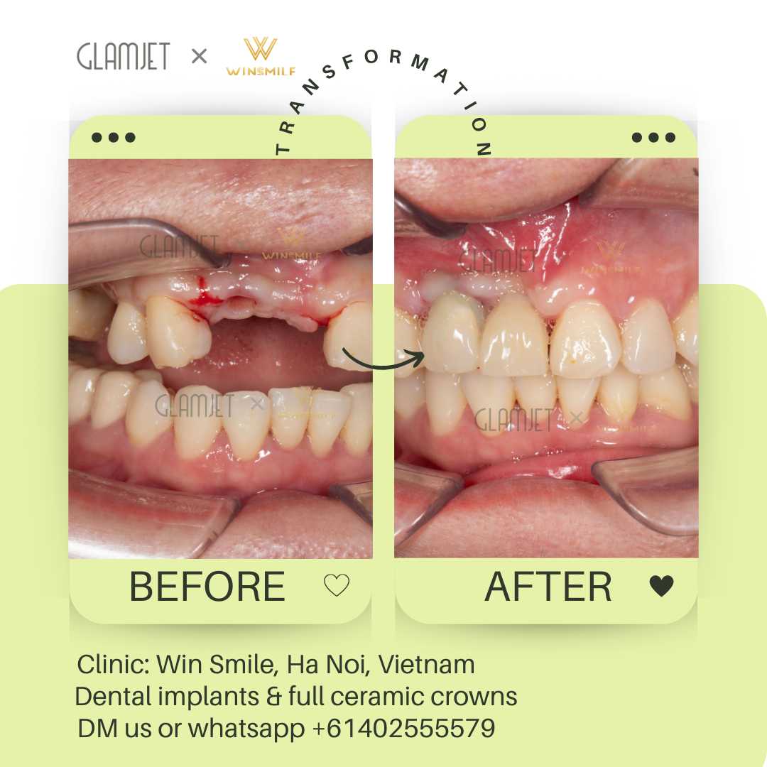 Transformative before and after images of dental implants for front teeth loss at a premium dental clinic in Hanoi, Vietnam. Glamjet helped clients from Australia, New Zealand, and America save significantly on dental costs while enjoying expertly planned dental tourism holidays in Vietnam, Bali, and Thailand that combine beautiful holidays and affordable porcelain crowns, no prep veneers, ceramic veneers, zygomatic implants, all-on-4 and all-on-6 implants, teeth whitening, root canal treatments, dentures