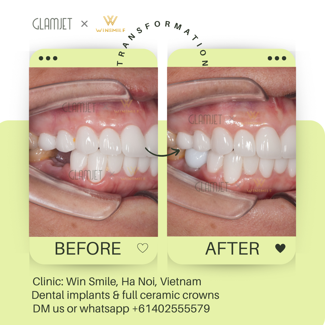 Before and after images of dental implants for teeth loss, showcasing affordable treatment at top dental clinic, Win Smile, with branches in Hanoi and Ho Chi Minh city in Vietnam. Glamjet arranges dental tourism holidays for many Australians, New Zealand, Canadian, Americans to Vietnam, Bali, and Thailand, offering services like porcelain crowns, Emax veneers, no prep veneers, porcelain veneers, all-on-4 and all-on-6 implants, teeth whitening, zygomatic implants, and dentures. Payment plans included