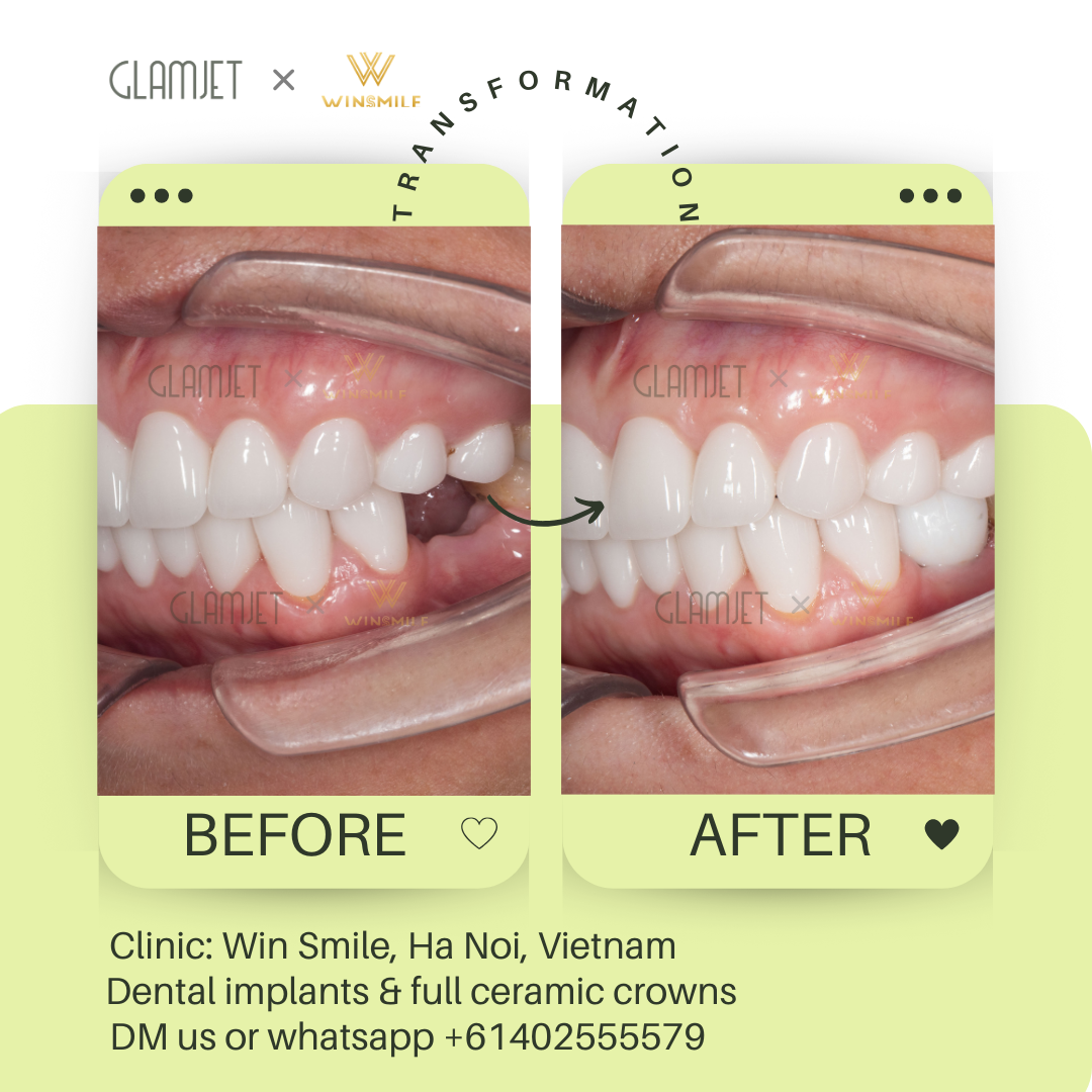 An image of before and after dental implant results for teeth loss, completed at a premium dental clinic in Hanoi. Glamjet simplifies planning dental tourism to Vietnam, Bali, and Thailand for many Australians, New Zeland, Americans, providing access to cost-effective porcelain crowns, no prep veneers, porcelain veneers, zygomatic implants, all-on-4 and all-on-6 implants, teeth whitening, root canal treatments. Payment plans available