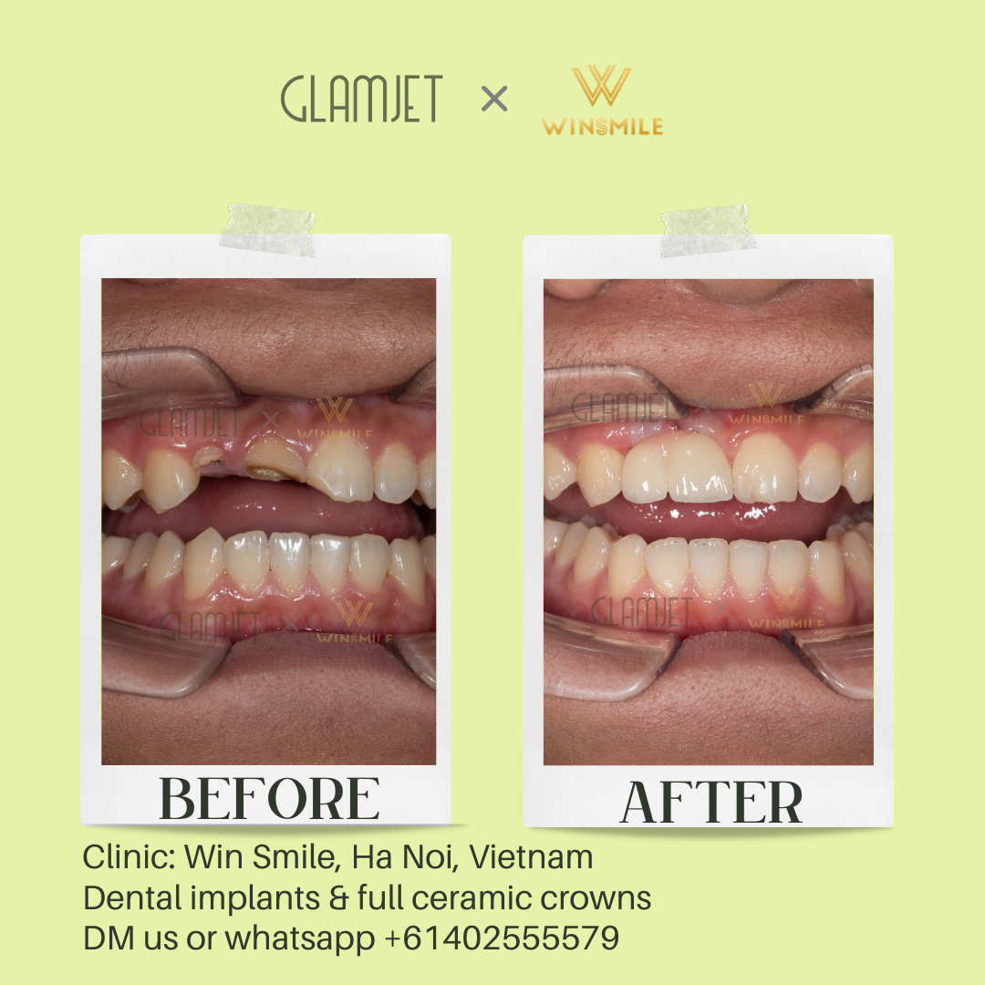 See the dramatic before and after transformation of dental implants for front teeth loss at a top-rated dental clinic with branches in Hanoi and Ho Chi Minh City, Vietnam. Glamjet organises dental holiday packages to Vietnam, Bali, Thailand, and South Korea for many Australians, New Zealand, Americans, British, combining holidays with affordable Emax veneers, no prep veneers, dentures, dental implants, all-on 4 and all-on-6 implants, zygomatic implants, and teeth whitening. Payment plan available