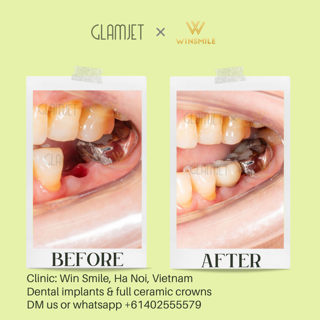 An image of teeth restored with dental implants performed at a top rated dental clinic in Hanoi, Vietnam. Glamjet offers seamless dental tourism planning to Vietnam, Bali, and Thailand, connecting Australian, New Zealand, American, Canadian clients with affordable treatments like porcelain crowns, no-prep veneers, Emax veneers, dental implants, all-on-4 and all-on-6 implants and dentures, root canal treatment, teeth whitening. Payment plans available.