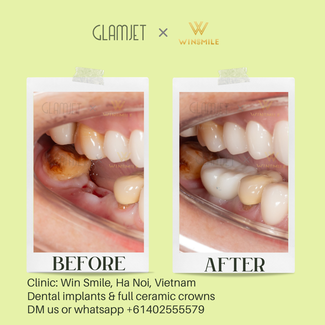 Before and after transformation of dental implants for teeth loss, performed at a top-rated dental clinic in Hanoi, Vietnam. Glamjet helped many clients in Australia, New Zealand, America organise Vietnam dental tourism holiday with ease, save dental cost on dental implants, porcelain crowns, no prep veneers, Emax ceramic veneers, all-on-4 and all-on-6 implants, root canal treatment, teeth whitening