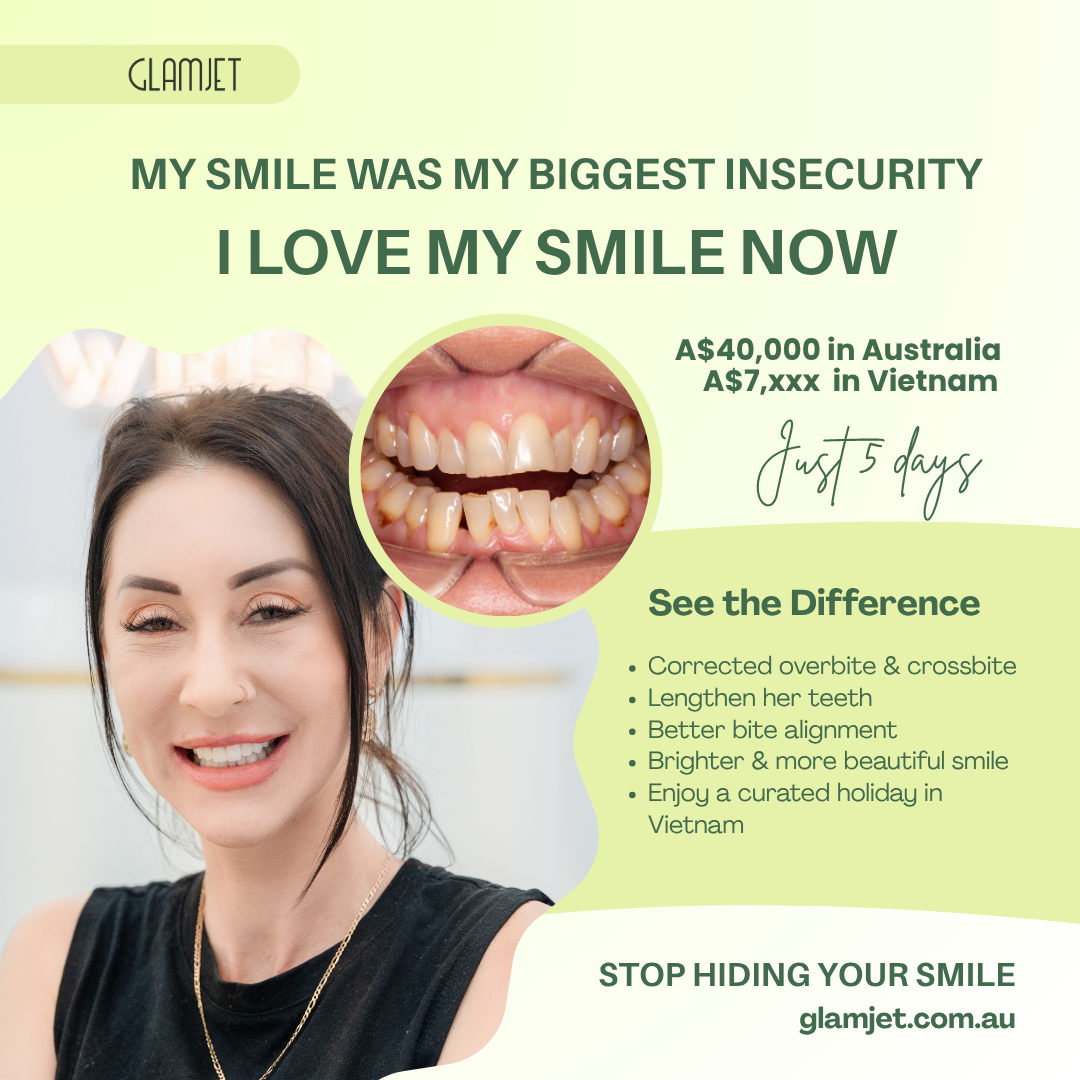 Before and after smile makeover of an Australian woman from Darwin who used to hide her smile due to cross bite and overbite. Glamjet.com.au arranged her dental holiday to Vietnam, where high-quality zirconia crowns restored her teeth and confidence. Such a beautiful, natural result with big savings.