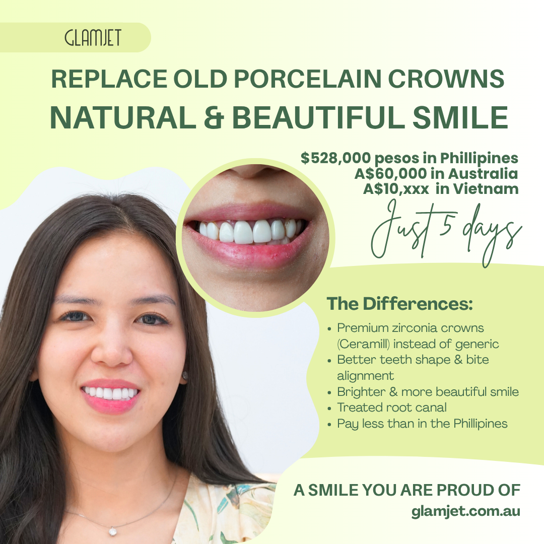 Before and after smile makeover of a Philippine client living in Australia who replaced old, bulky porcelain crowns with dark margins through Glamjet.com.au. After comparing prices in Vietnam, the Philippines, and Australia, she chose affordable, high-quality zirconia crowns in Hanoi with Glamjet’s trusted dental tourism service, translation support, and flexible payment plans.