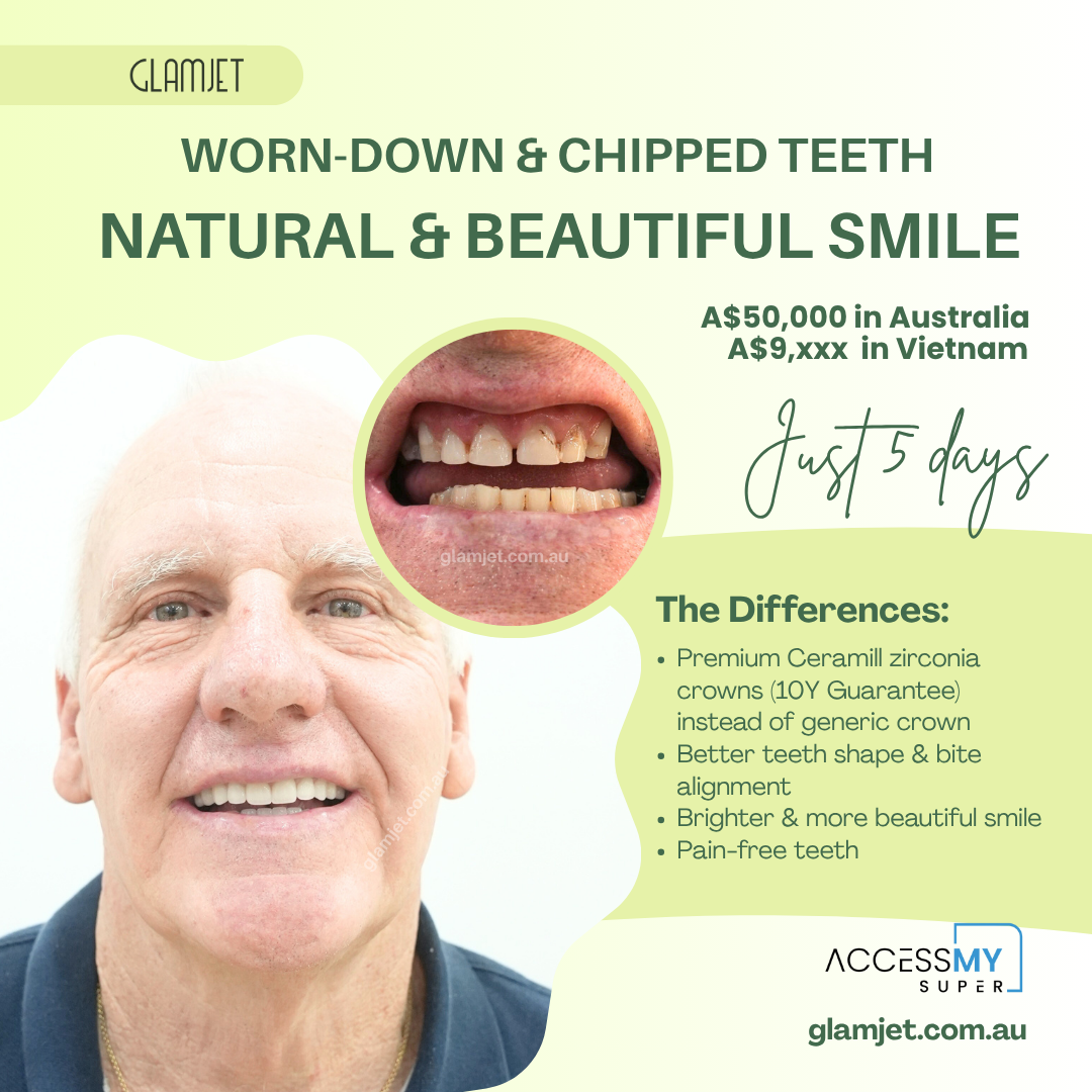 Before and after smile transformation of a Brisbane CEO with worn and chipped teeth from bruxism. During a business trip, he worked with Glamjet.com.au to arrange a full smile makeover overseas, including dental implants and zirconia crowns. He now loves smiling again and recommends Glamjet.com.au for trusted, high-quality dental treatments abroad.