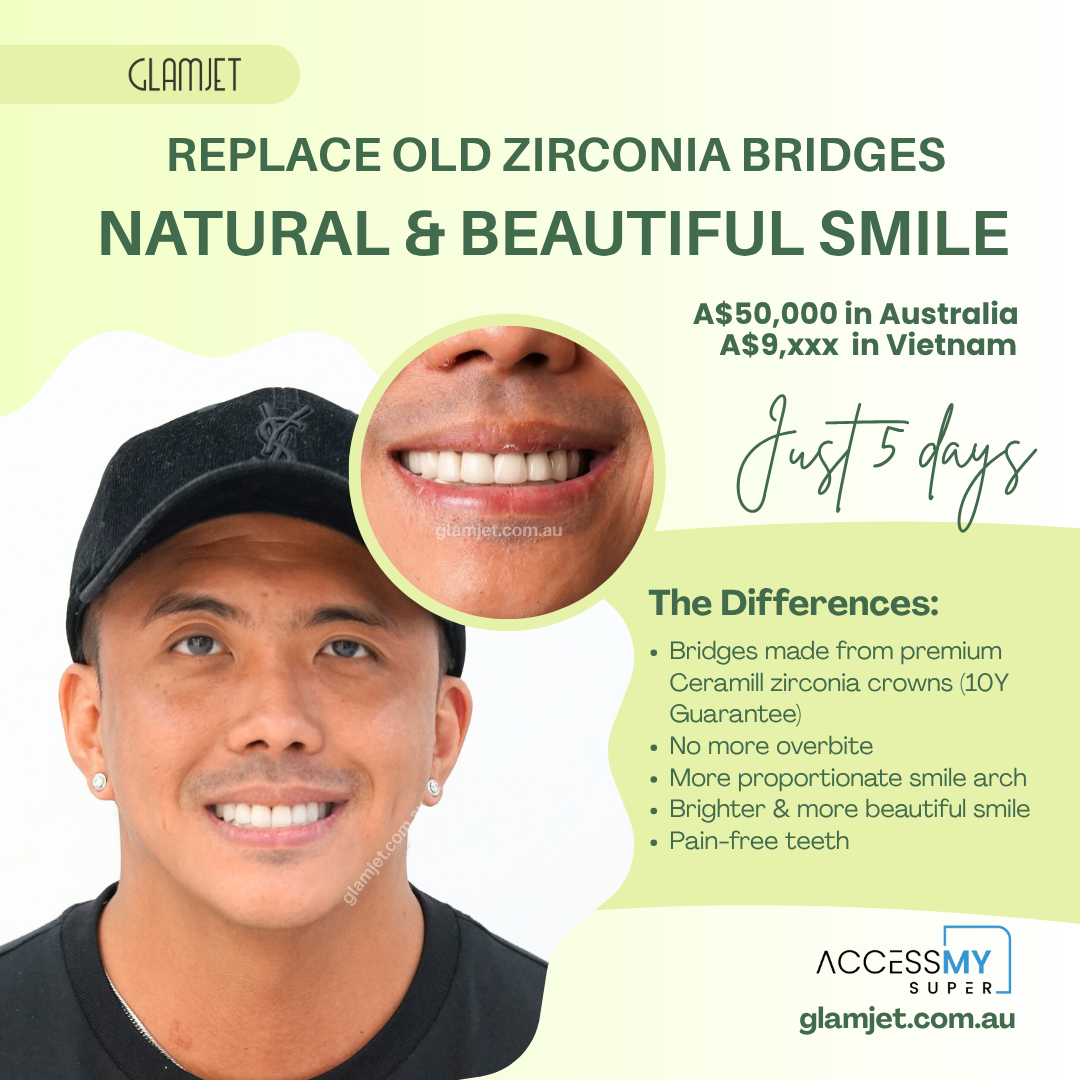 Before and after smile makeover of a male nurse from the Philippines who replaced bulky, inflamed dental bridges that caused an overbite. After comparing prices in Vietnam, Australia, and the Philippines, he chose Glamjet.com.au for affordable, high-quality zirconia crowns and fixed bridges in Vietnam. He now feels confident and handsome with his new smile.