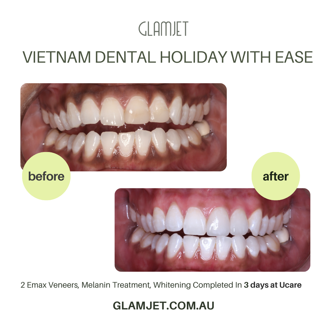 Before and after image of an amazing smile transformation of an American client at a top rated dental clinic in Ho Chi Minh city, Vietnam. She had dark gum and small and uneven teeth.  She had 2 Emax ceramic veneers and melanin gum treatment, and teeth whitening. Glamjet Dental Holiday transformed her smile to bright, white and with shapes more proportion to her face. Dental Treatment Prices  are affordable for Australians, New Zealanders, and Americans with the best dentists in Vietnam and payment plans.