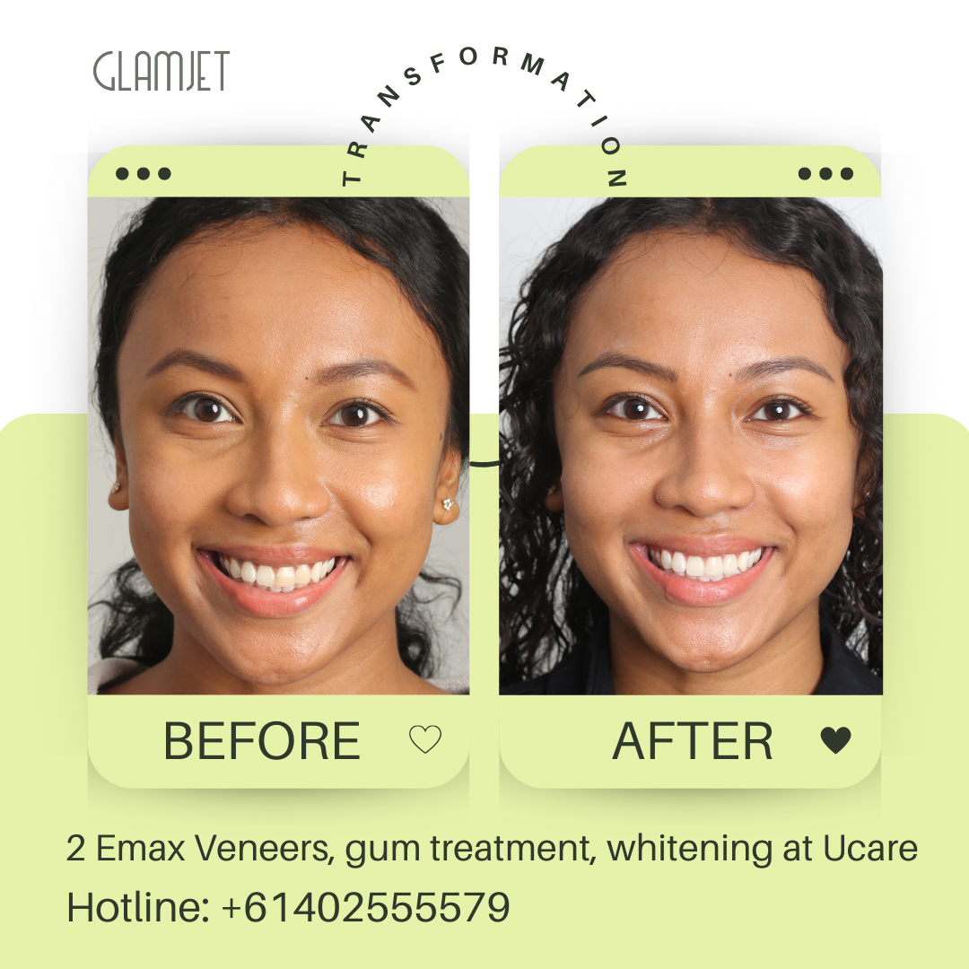 Stunning image of a client from the USA travelling to Vietnam to do melanin gum treatment, two Emax Ceramic Veneers, and teeth whitening at Ucare Dental Clinic in Ho Chi Minh city, Vietnam with Glamjet. Glamjet Dental Holiday combines expert dental care at top rated dental clinics with breathtaking travel experiences in Hanoi, Ho Chi Minh City, and Da Nang. Glamjet's medical concierge service is trusted by many clients in Australians, New Zealand, and the USA.