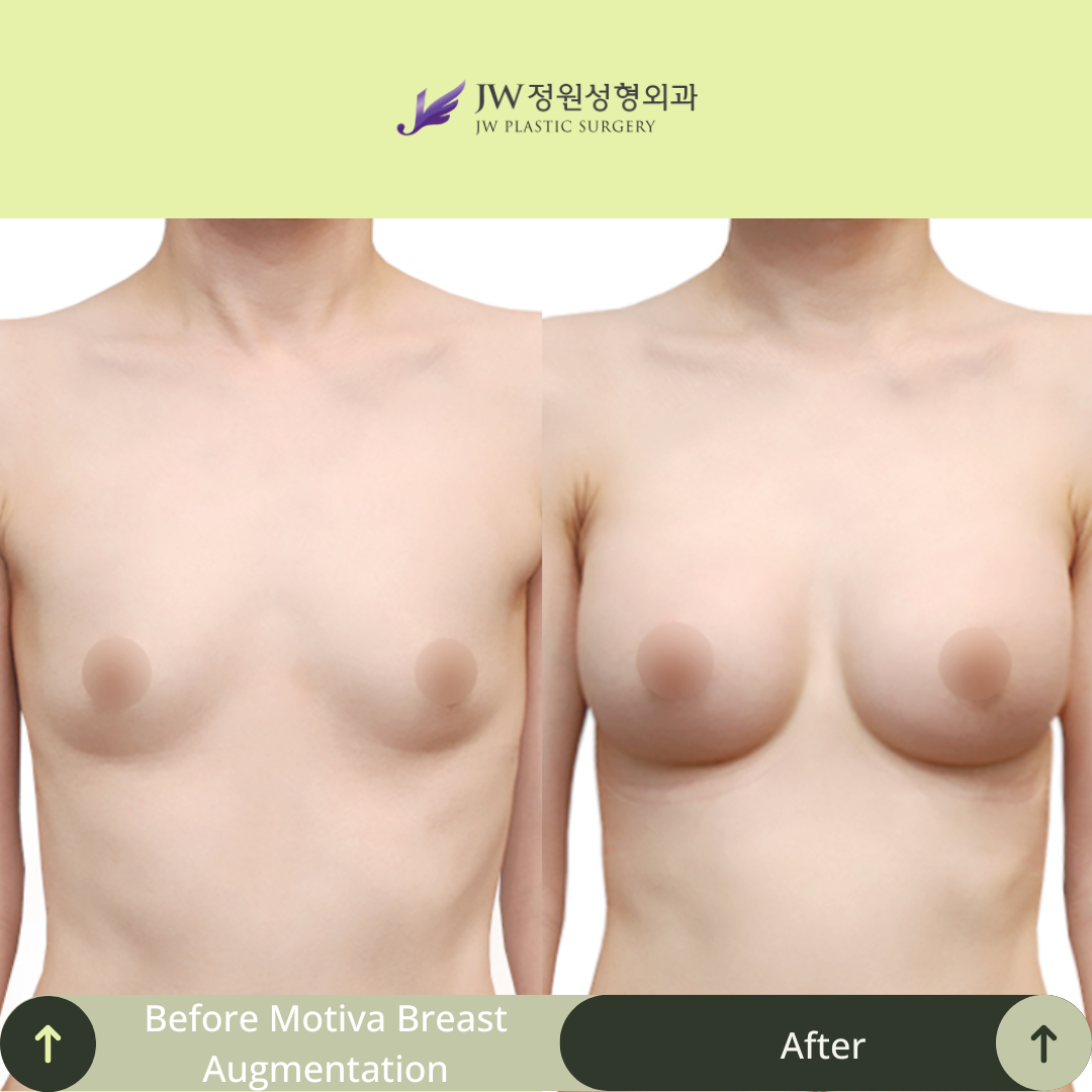 Breast Augmentation Surgery Packages In South Korea