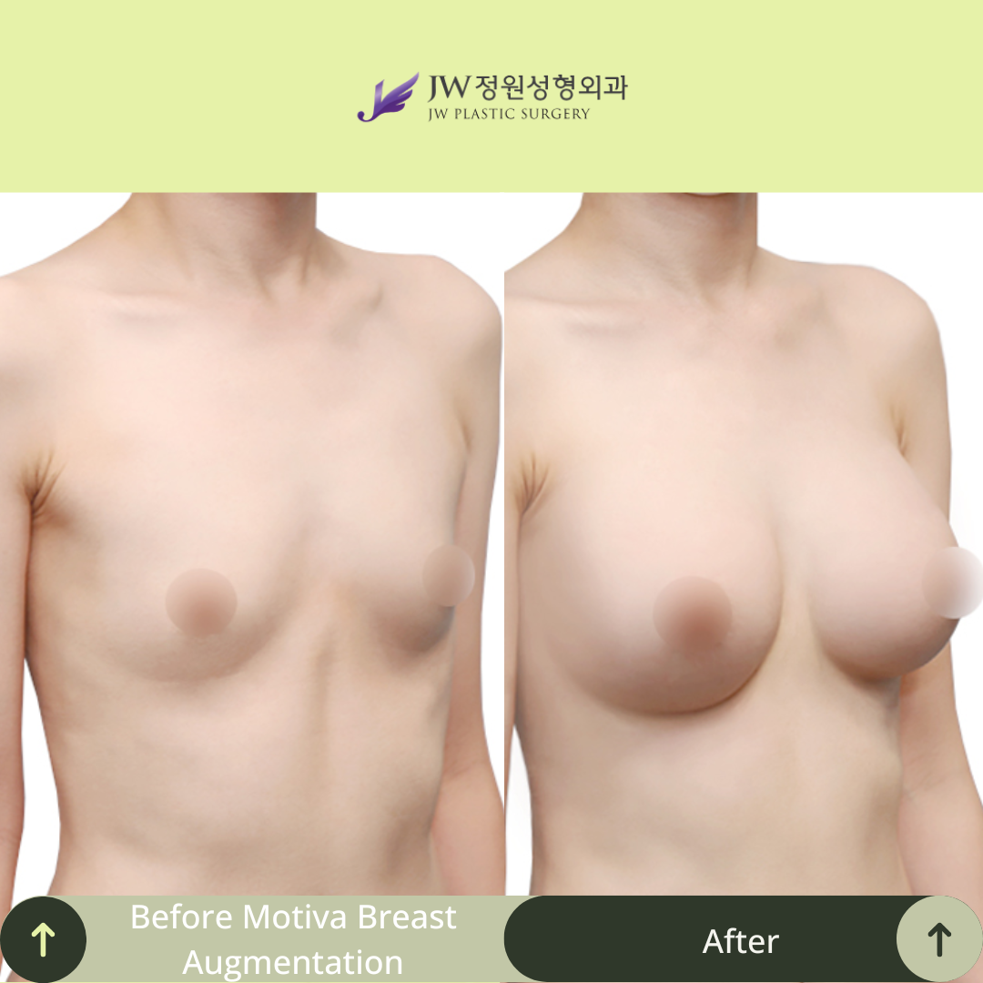Breast Augmentation Surgery Packages In South Korea