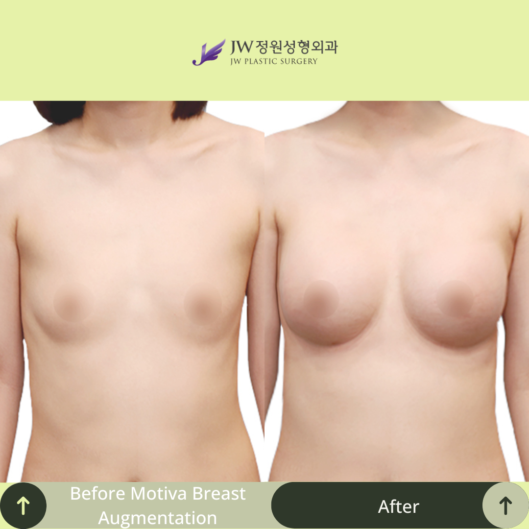 Breast Augmentation Surgery Packages In South Korea