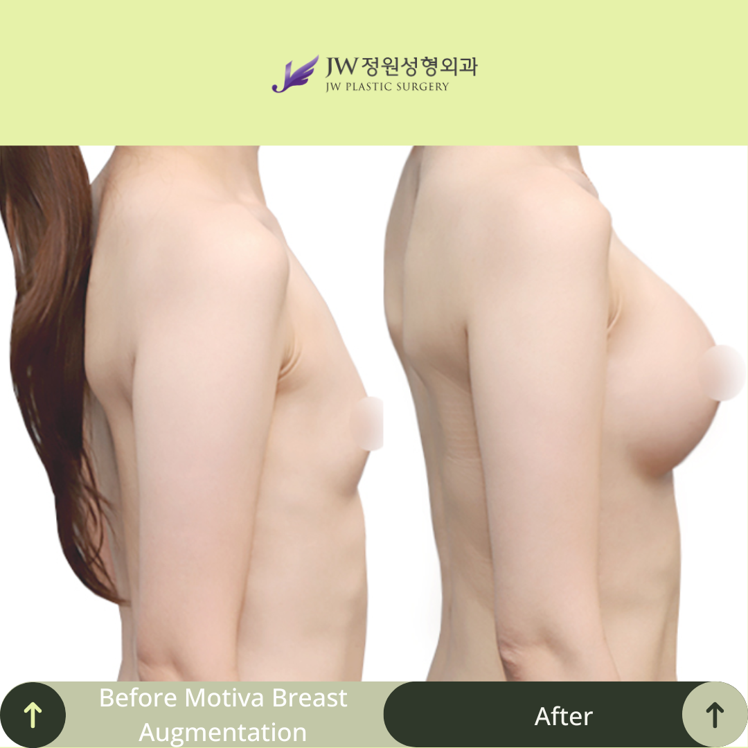 Breast Augmentation Surgery Packages In South Korea