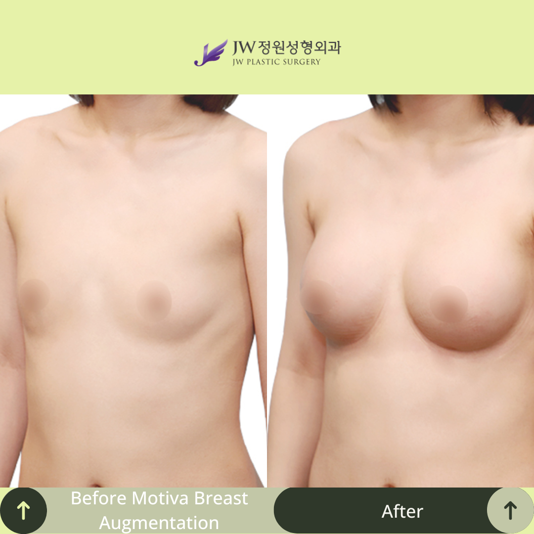 Breast Augmentation Surgery Packages In South Korea