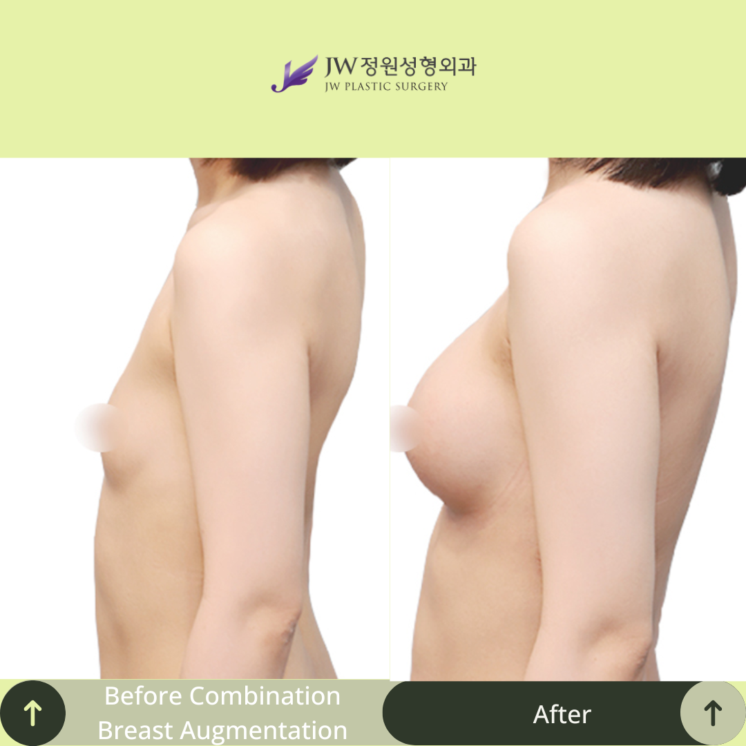 Breast Augmentation Surgery Packages In South Korea