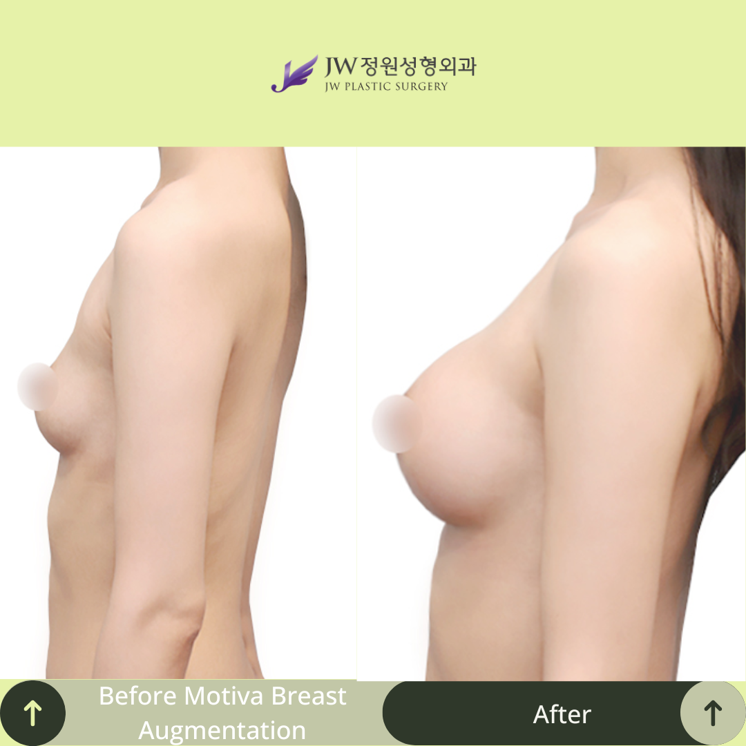 Breast Augmentation Surgery Packages In South Korea