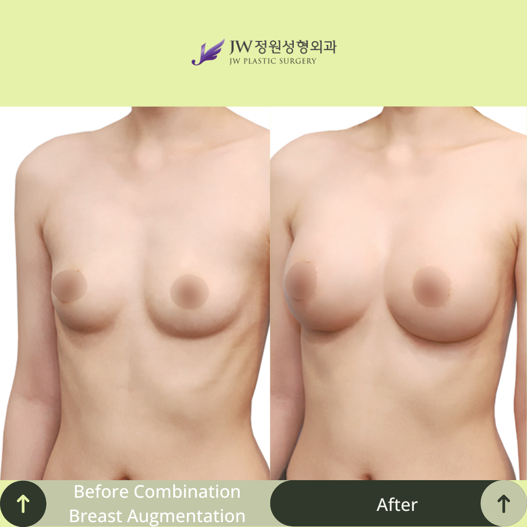 Breast Augmentation Surgery Packages In South Korea