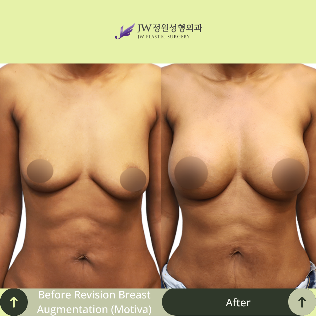Breast Augmentation Surgery Packages In South Korea