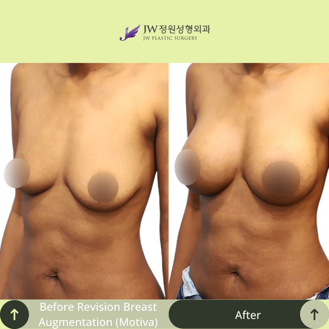Breast Augmentation Surgery Packages In South Korea
