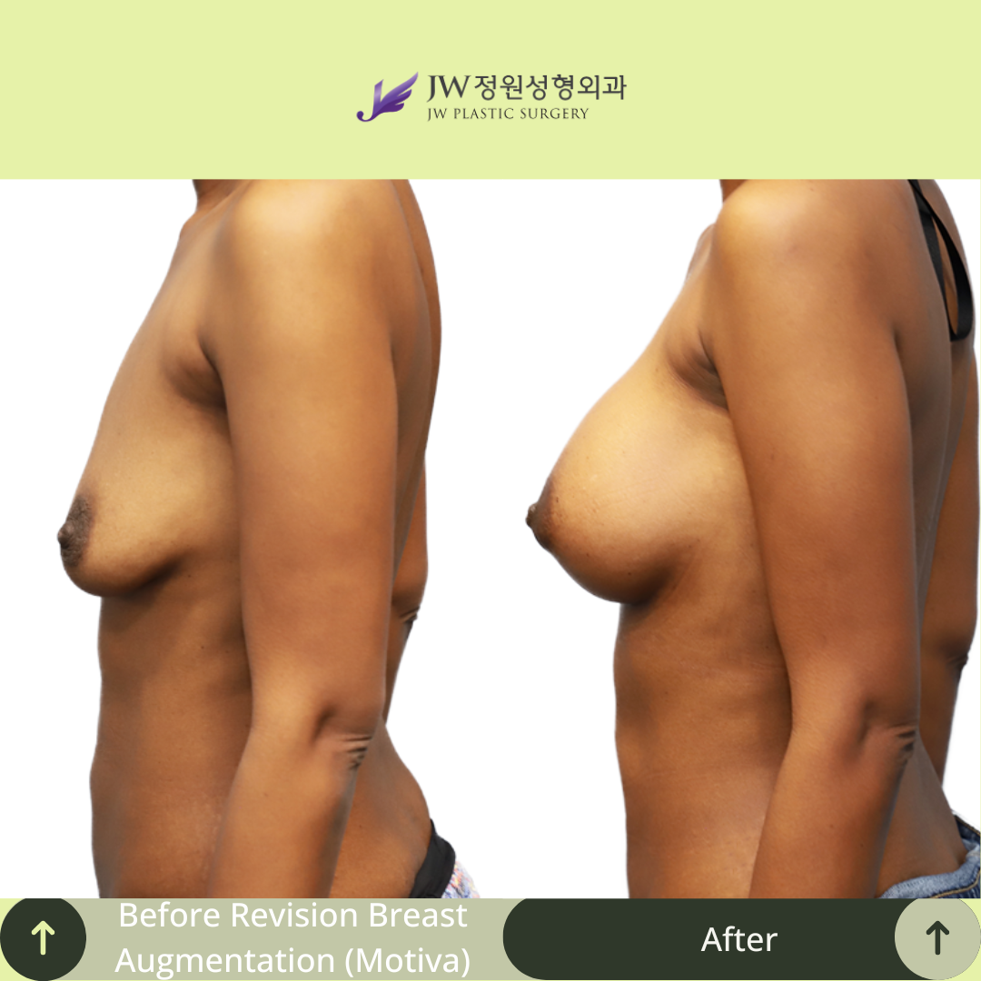 Breast Augmentation Surgery Packages In South Korea