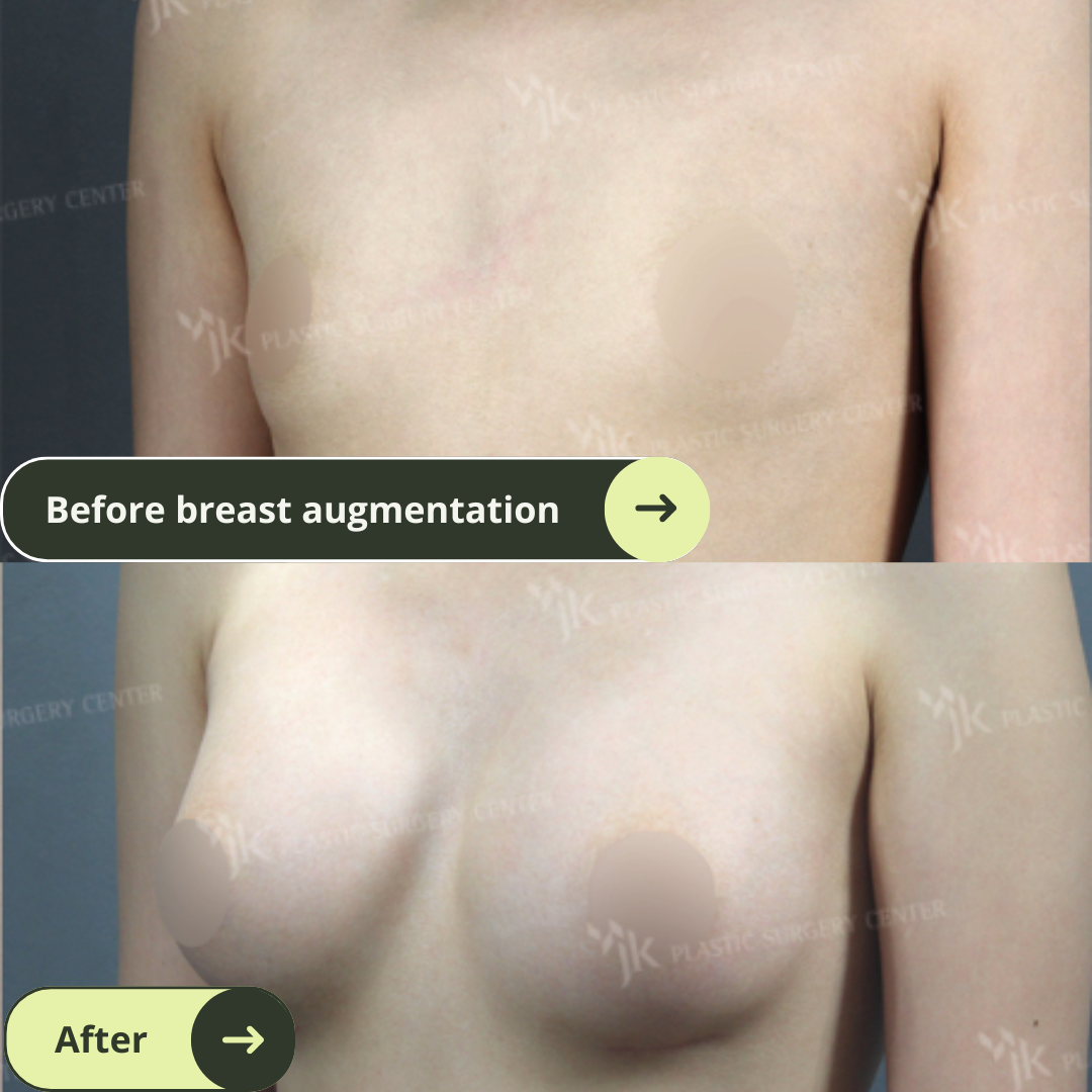 Breast Augmentation Surgery Packages In South Korea