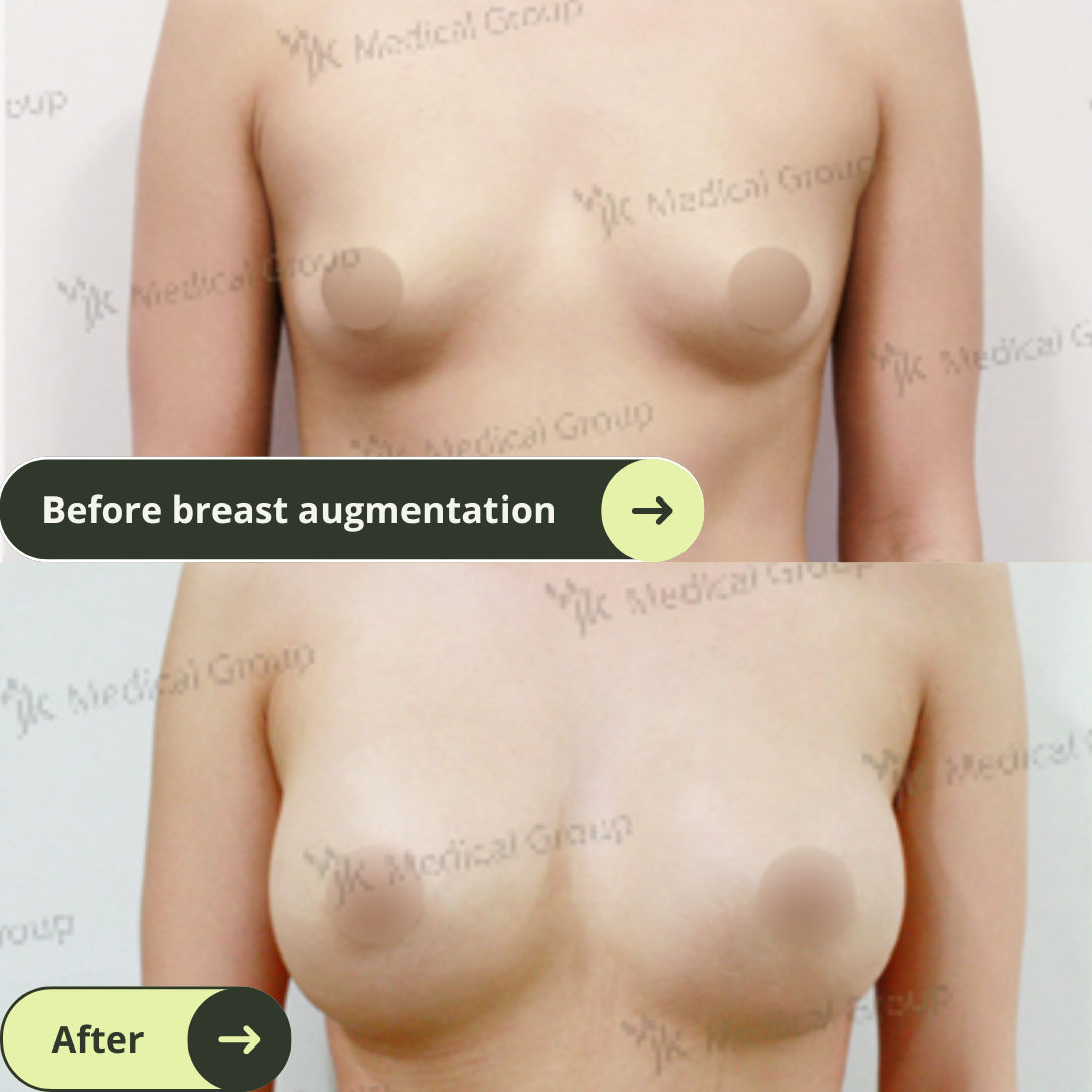 Breast Augmentation Surgery Packages In South Korea