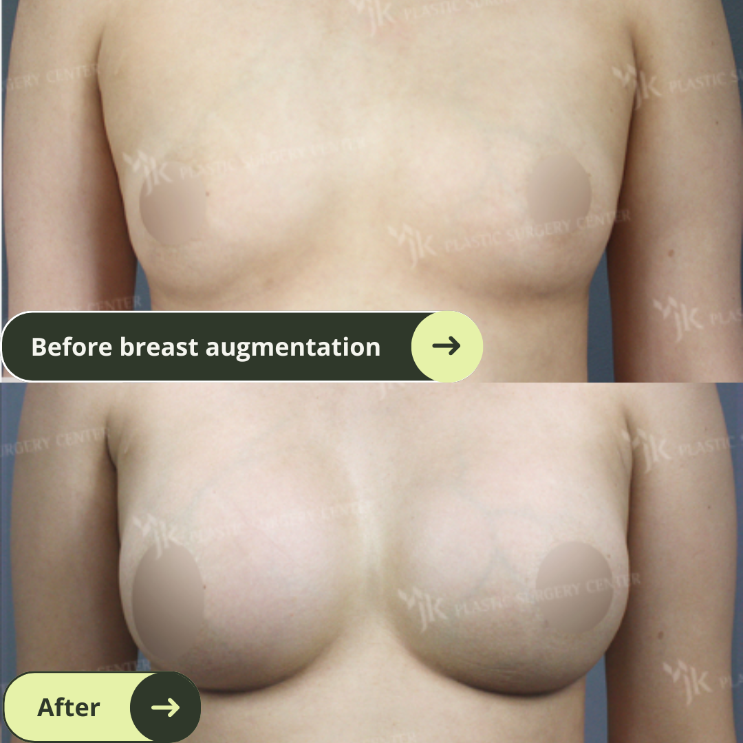 Breast Augmentation Surgery Packages In South Korea