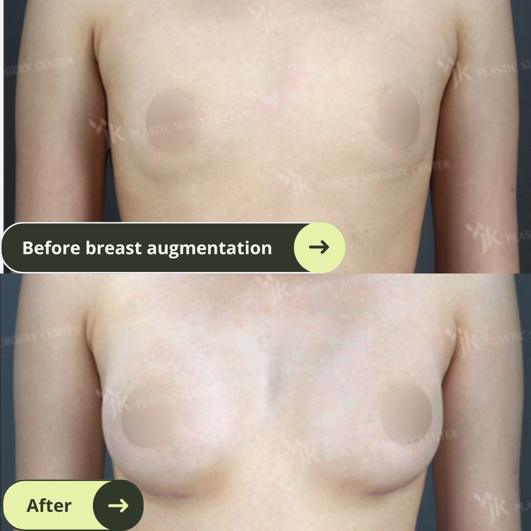 Breast Augmentation Surgery Packages In South Korea