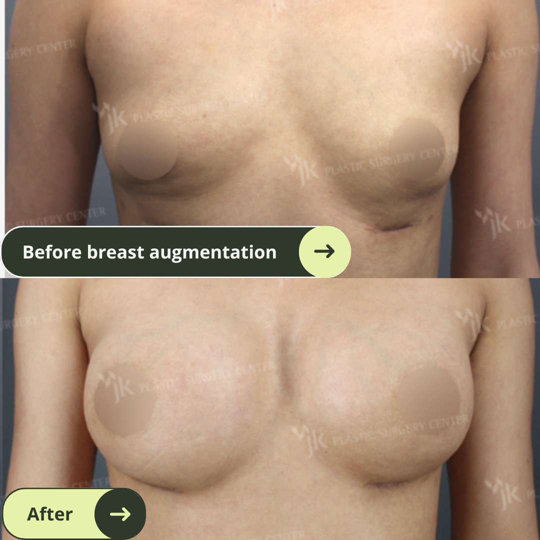 Breast Augmentation Surgery Packages In South Korea