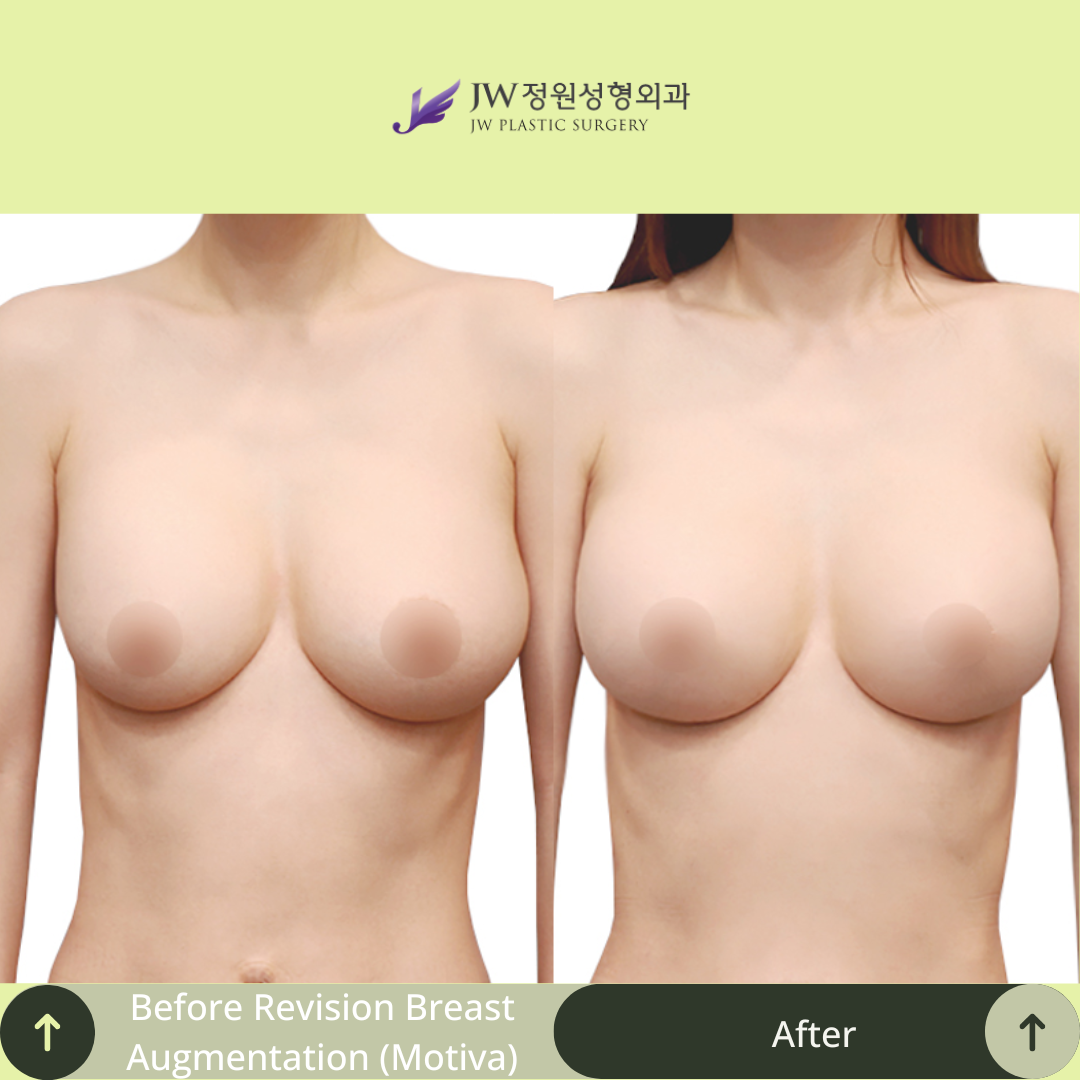 Breast Augmentation Surgery Packages In South Korea