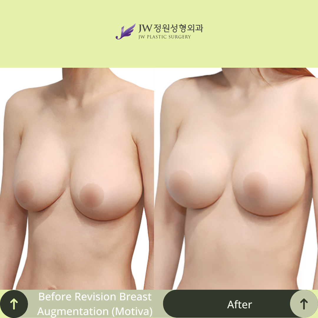 Breast Augmentation Surgery Packages In South Korea