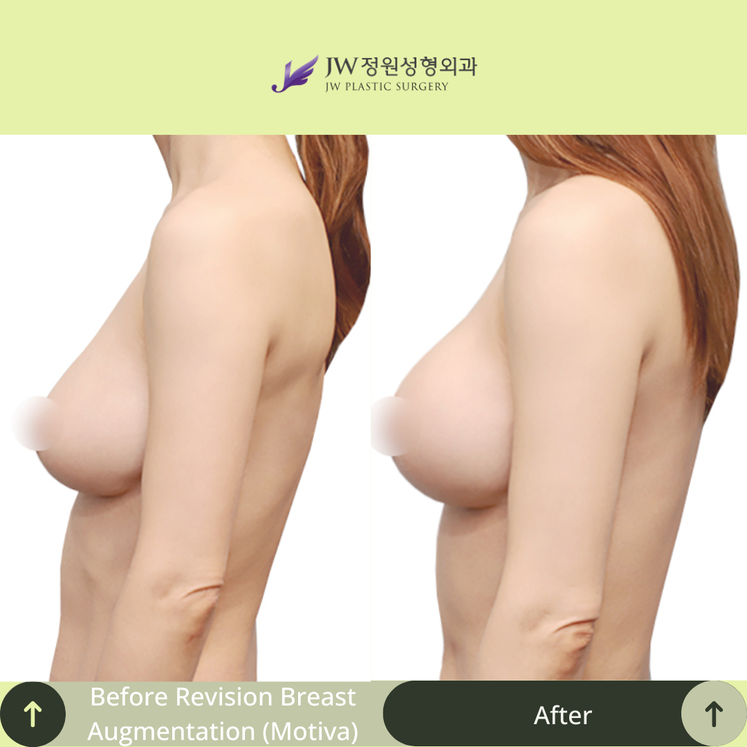 Breast Augmentation Surgery Packages In South Korea