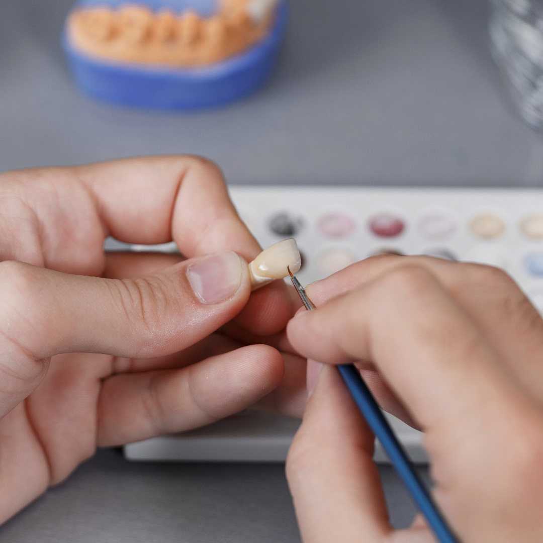 A dental technician working create customised veneers. Emax porcelain veneers packages  in Vietnam are much more affordable than in Melbourne, Sydney, Perth, or Brisbane, Australia. Emax veneers are more premium than traditional veneer. They look translucent and mimic the colour of natural teeth. Glamjet offers 6 veneer, 10 veneer, 16 veneer packages in Vietnam, Thailand, and South Korea with payment plans. Price of porcelain veneers are 70% cheaper than Australia.