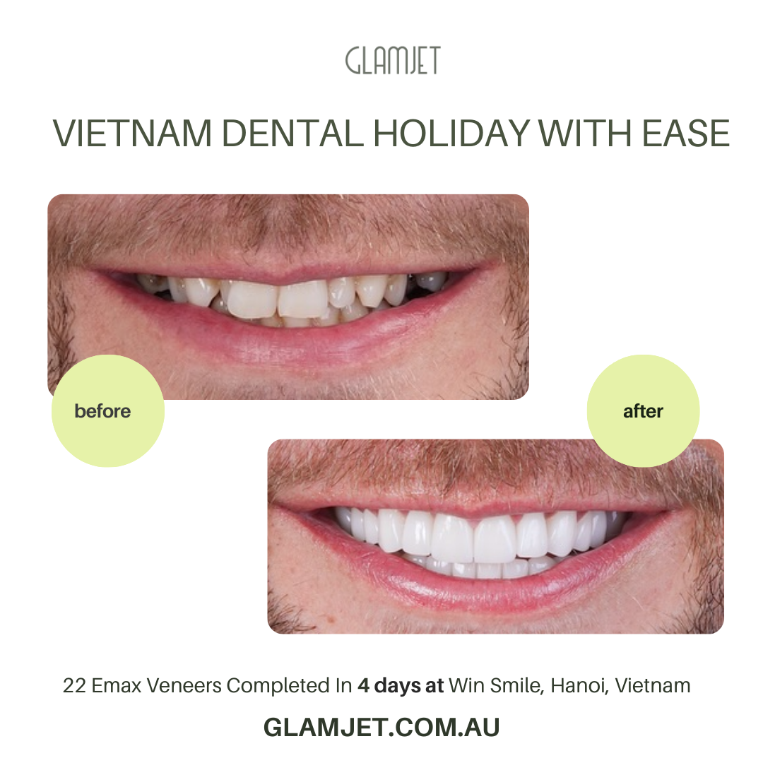 Before and after images of smile makeover with 22 Emax Ceramic Veneers no prep at Win Smile Dental Clinic in Ha Noi, Vietnam. Dental holiday in Vietnam was arranged by Glamjet Dental Holiday company. Glamjet connect top-rated veneer dentists with clients in Australia, New Zealand, and the USA.