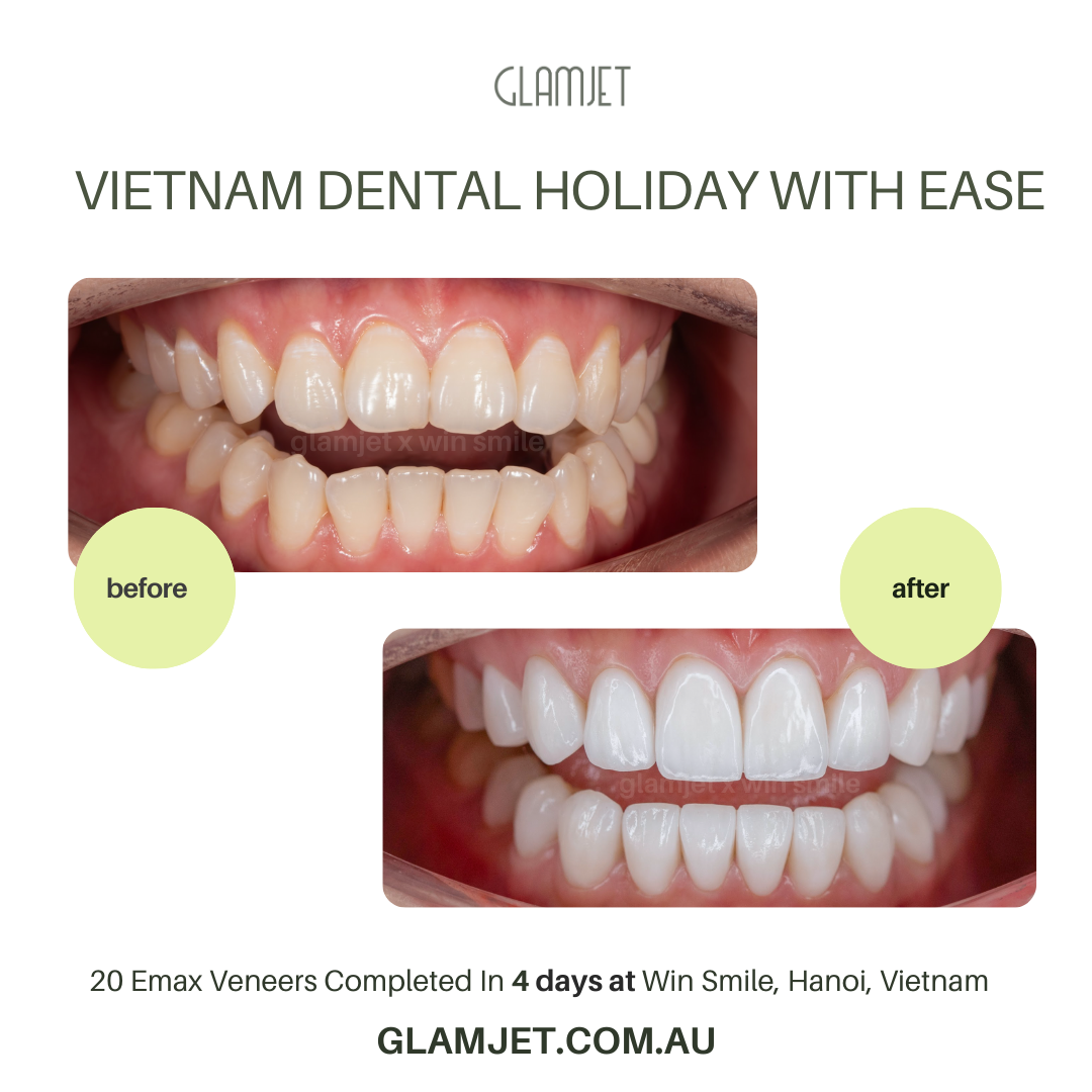 Stunning before and after Emax Ceramic Veneers at Win Smile Dental Clinic, Hanoi. Glamjet Dental Holiday ensures top-notch dental care with leading dentists in Hanoi and Ho Chi Minh City, along with immersive Vietnam travel experiences. Minimal dental preparation or no preparation available. No shave teeth