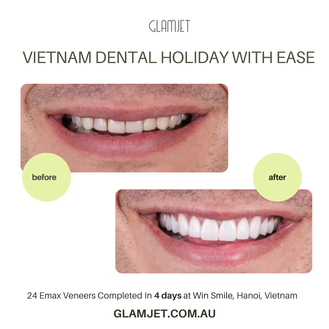Before and after images showcasing a stunning smile makeover with Emax Ceramic Veneers (no prep) at Win Smile Dental Clinic, Hanoi, Vietnam. This transformative dental holiday was arranged by Glamjet Dental Holiday, a trusted agency connecting clients from Australia, New Zealand, and the USA with top-rated veneer specialists in Vietnam. Experience world-class cosmetic dentistry combined with an unforgettable Vietnam travel adventure.