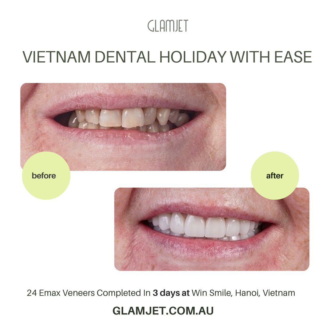 Complete smile transformation with Emax Ceramic Veneers at Ucare Dental Clinic, Hanoi, Vietnam. These are before and after photos. Glamjet Dental Holiday specializes in arranging seamless dental tourism for clients from Australia, New Zealand, and the USA, offering premium no-prep and minimal-prep veneer services alongside unforgettable Vietnam travel experiences.