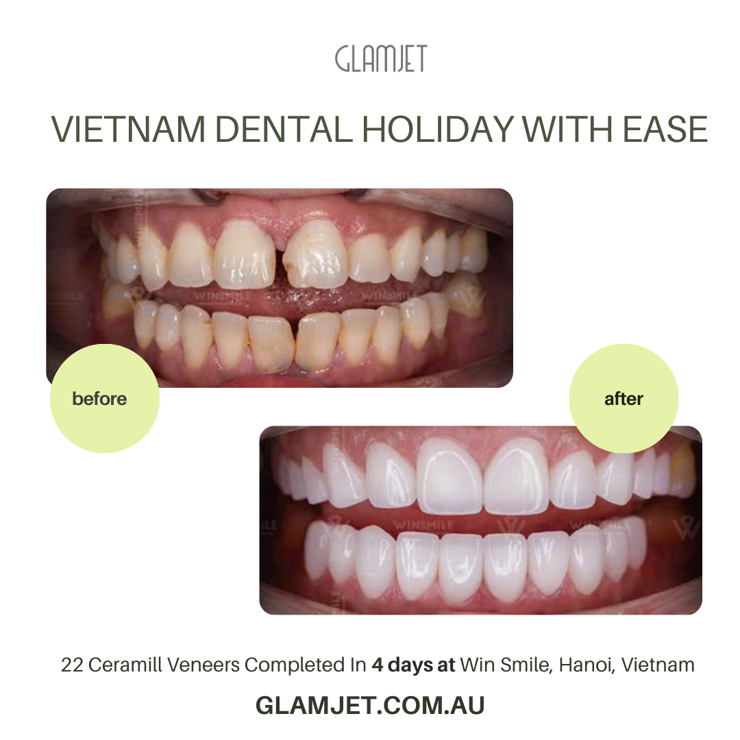 Emax Ceramic Veneers (no-prep) deliver flawless results at Win Smile Dental Clinic, Hanoi, Vietnam. Glamjet Dental Holiday connects clients with expert dentists in Hanoi and Ho Chi Minh City, combining dental care with Vietnam’s top travel experiences. Glamjet helps many clients in Australia, New Zealand, and the USA save up to 80% costs. No prep and minimal prep veneers are available. No shave teeth. Clients are able to remove teeth gaps.