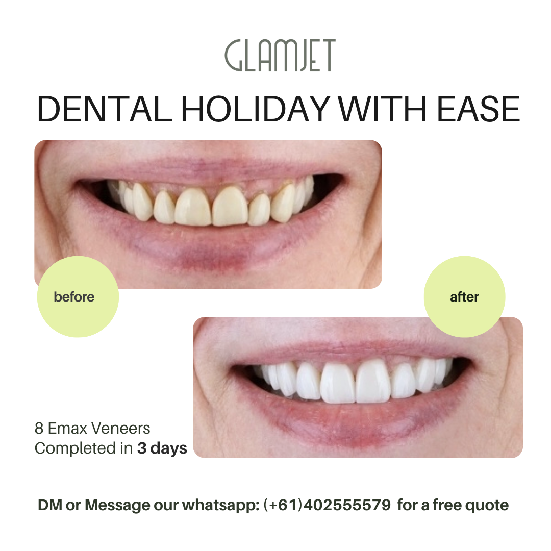 Achieve your dream smile and replace your old porcelain veneers with Emax Ceramic Veneers at Ucare Dental Clinic, Hanoi. Glamjet Dental Holiday provides no-prep and minimal-prep veneer services at costs much lower than in Australia, New Zealand, and the USA, with a chance to explore Vietnam.