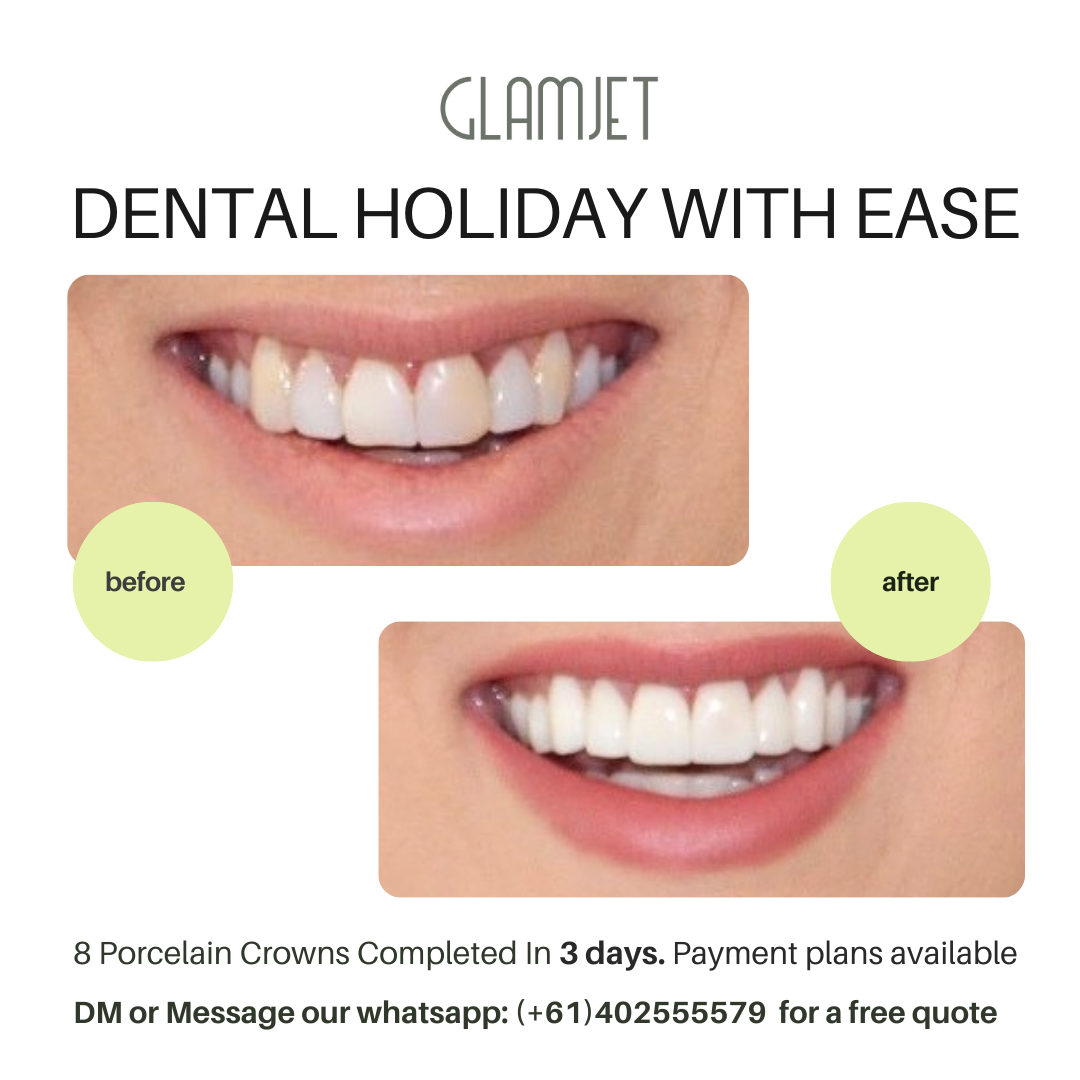 Smile makeover results using Emax Ceramic Veneers at Ucare Dental Clinic, Hanoi, Vietnam. Glamjet Dental Holiday partners with top dentists to offer no-prep and minimal-prep veneers at affordable prices, along with exciting Vietnam travel options. If you are looking for veneer replacement, glamjet to Vietnam to transform your smile.