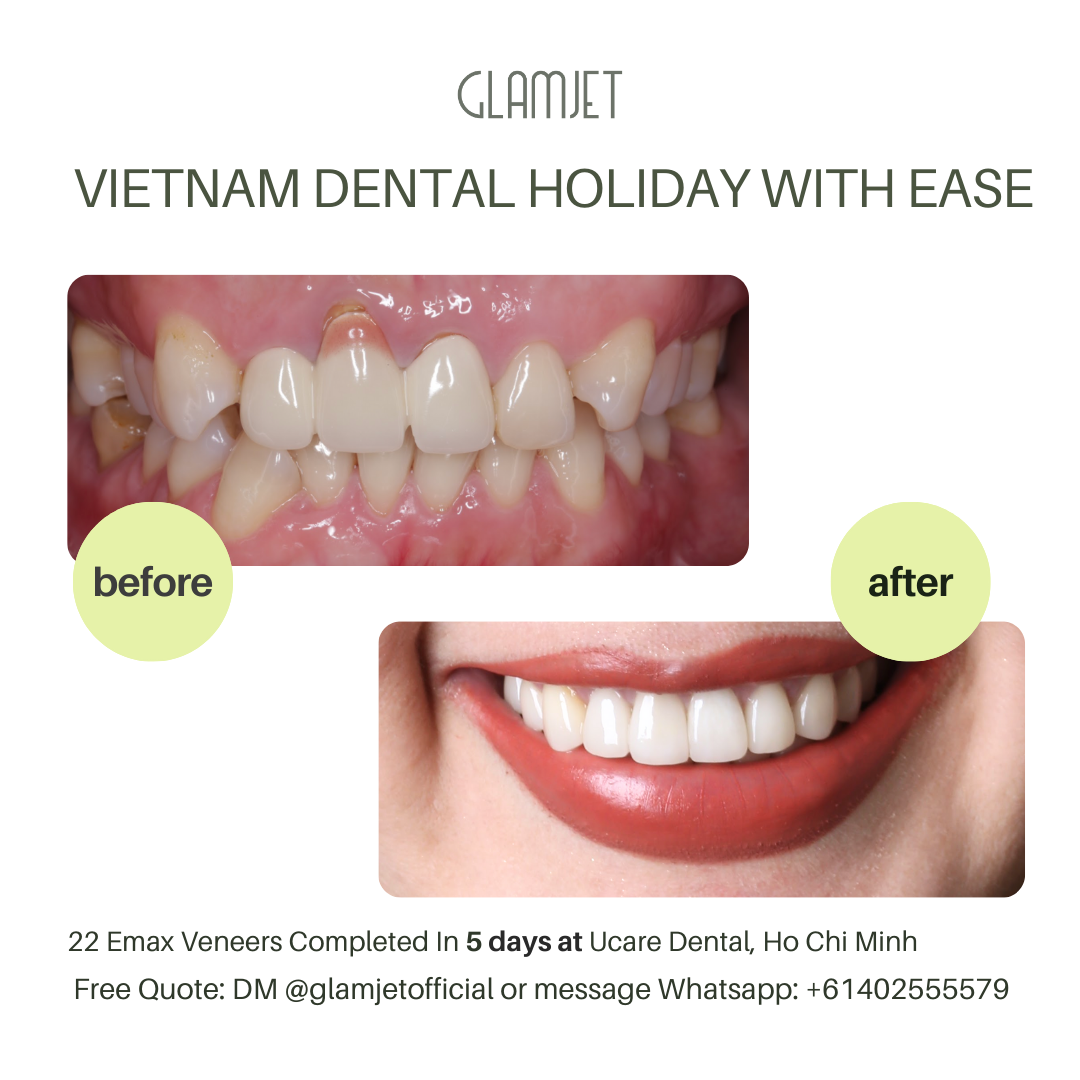 Smile makeover results using Emax Ceramic Veneers at Ucare Dental Clinic, Hanoi, Vietnam. Glamjet Dental Holiday partners with leading dentists in Hanoi and Ho Chi Minh City to provide no-prep and minimal-prep veneer solutions for international dental tourists travelling from Australia, New Zealand, and the USA.